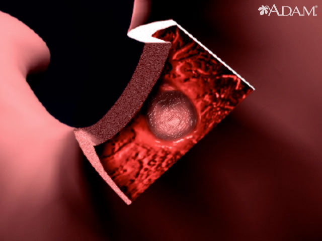 Stomach ulcer