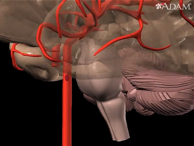 Stroke - secondary to cardiogenic embolism