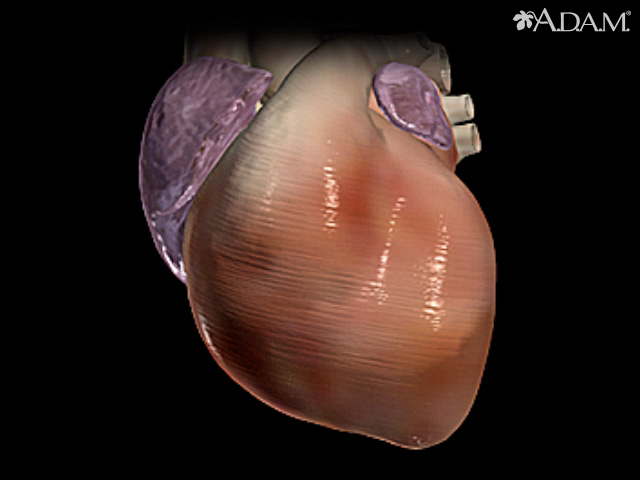 Tachycardia