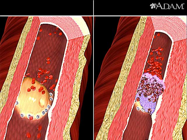 Tobacco use - effects on arteries
