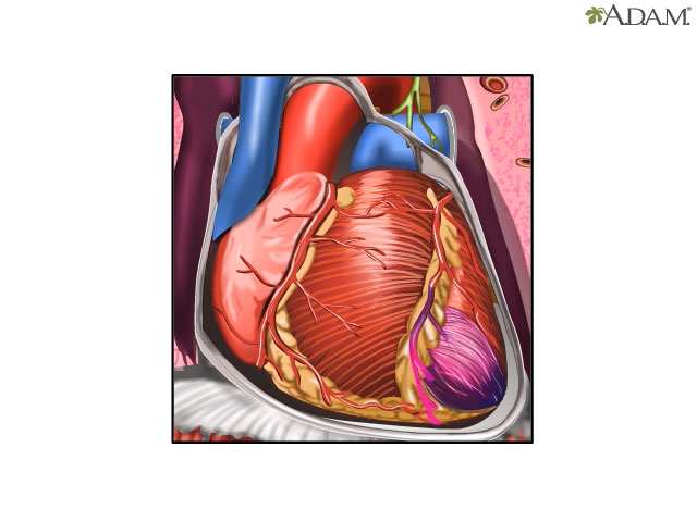 Coronary artery disease