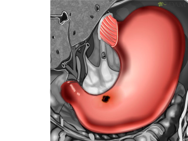 Stomach ulcer