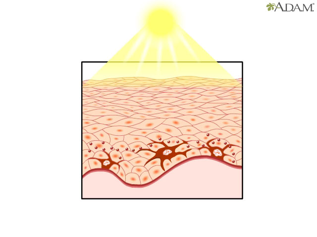Sun's effect on skin