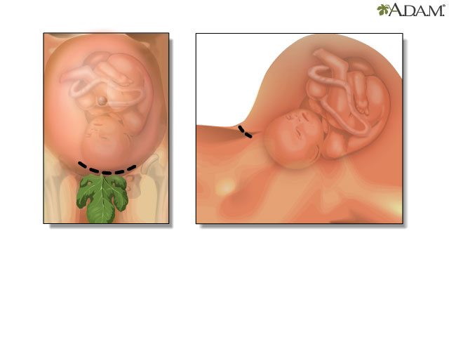 Cesarean section