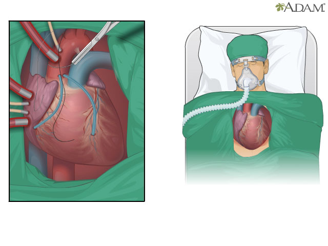 Coronary artery bypass graft (CABG)