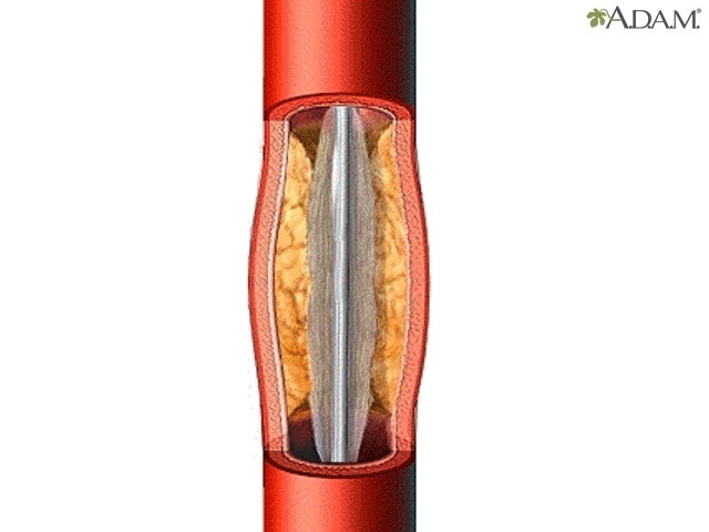 Percutaneous transluminal coronary angioplasty (PTCA)