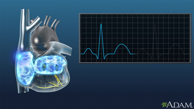 HIE Multimedia - Paroxysmal supraventricular tachycardia (PSVT)