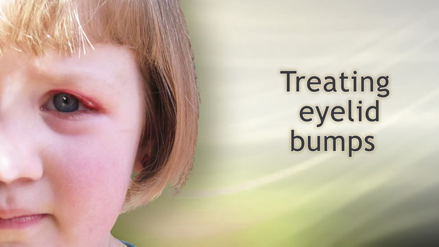 Treating eyelid bumps