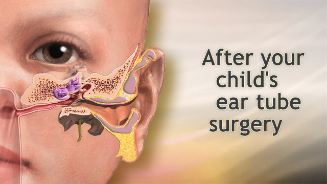 After your child's ear tube surgery