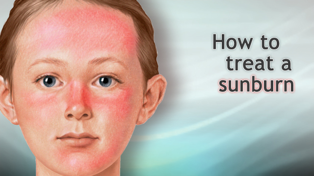 How to treat a sunburn