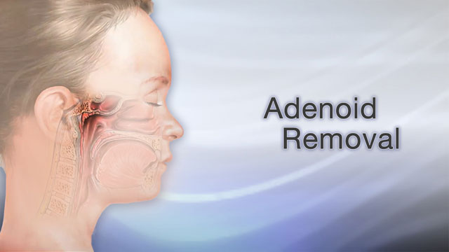 Adenoid removal