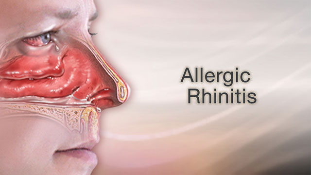 Allergic rhinitis