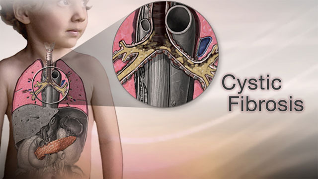 Cystic fibrosis