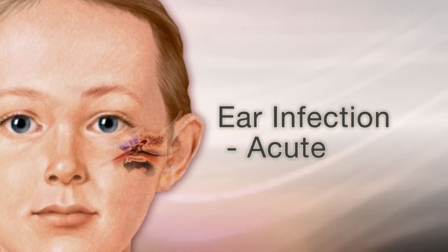 Ear infection - acute
