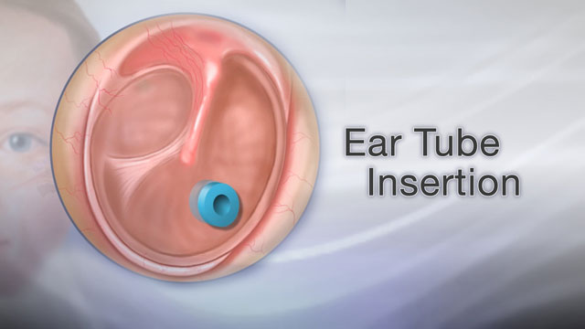 Ear tube insertion