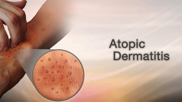 Atopic dermatitis