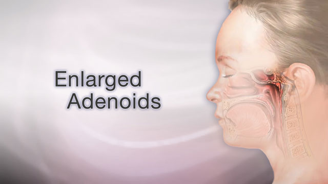 enlarged adenoid