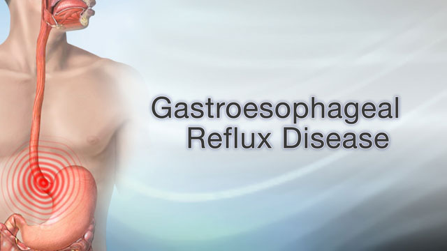 Gastroesophageal reflux disease