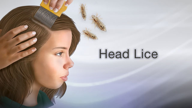 Head lice