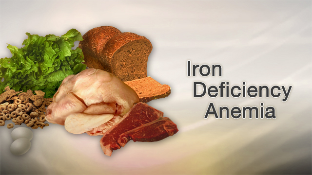 Iron deficiency anemia