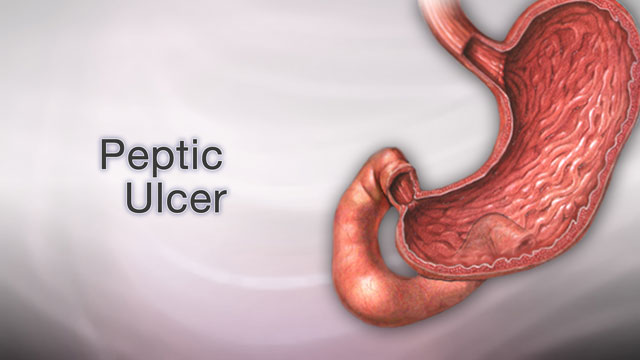 Peptic ulcer