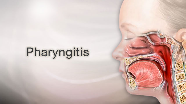 Pharyngitis