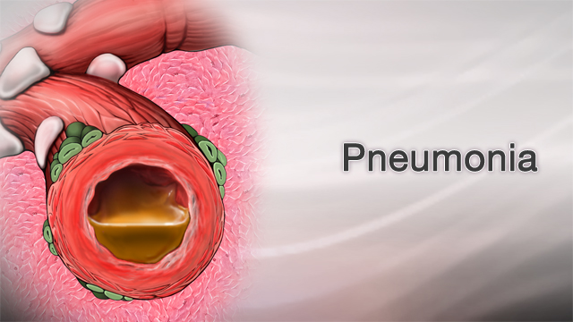 Pneumonia