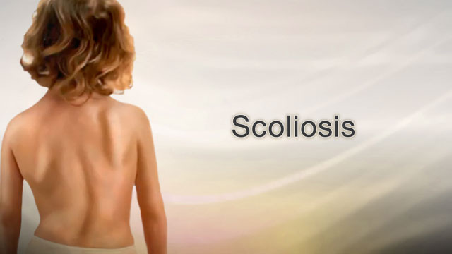 Scoliosis