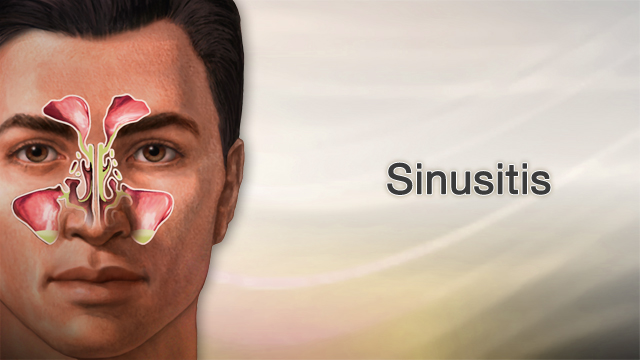 What causes deals sinus infections