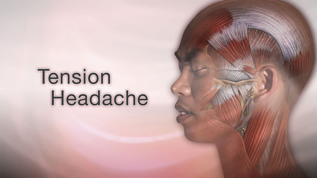 Tension Headache Information Mount Sinai New York