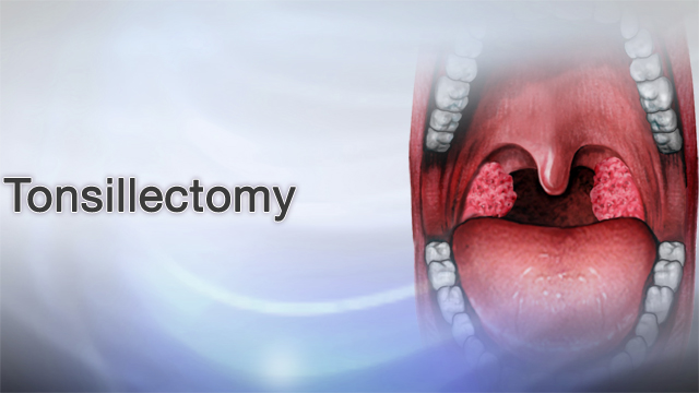 Tonsillectomy