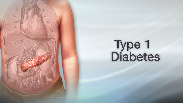 Type 1 diabetes