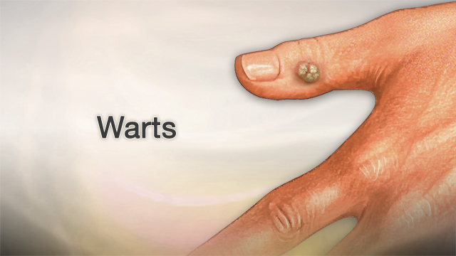 Warts