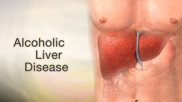 Alcoholic liver disease