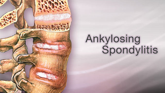 Ankylosing spondylitis