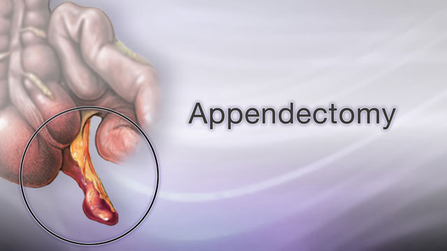 Appendicitis Information