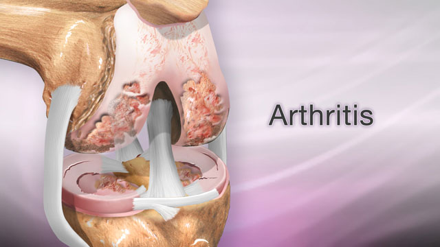 Arthritis