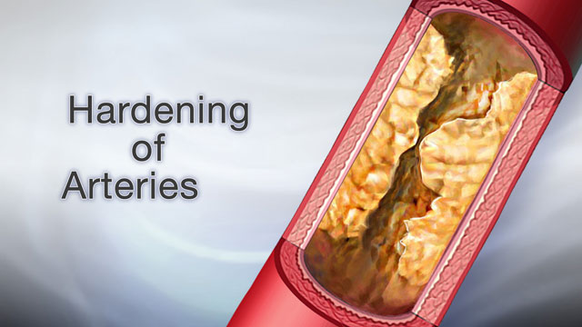 Hardening of arteries