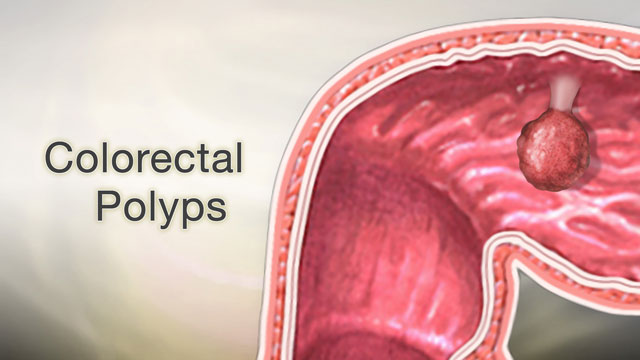 Colorectal polyps