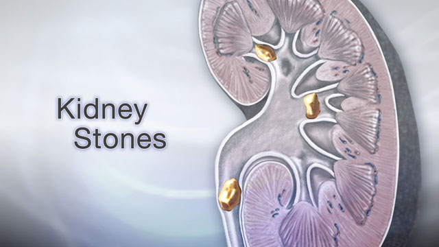 Kidney stones