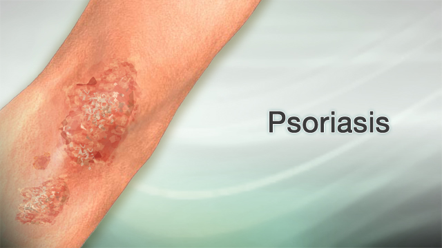 Psoriasis 