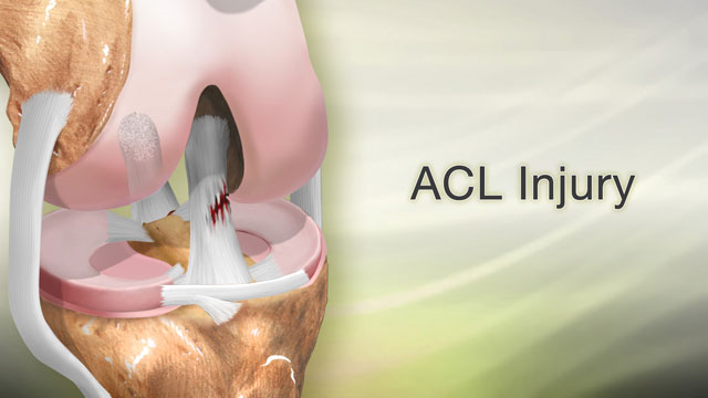 ACL Injury - What You Need to Know
