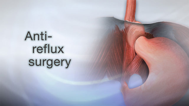 Anti-reflux surgery