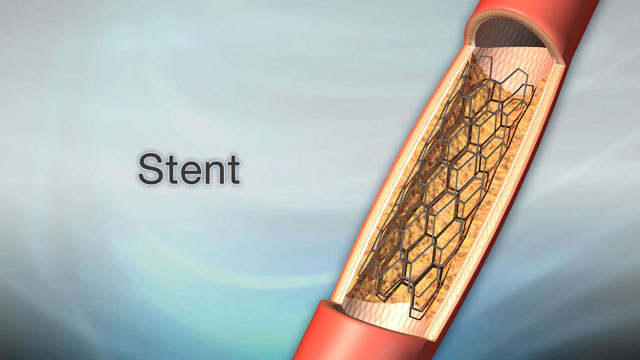 Stent