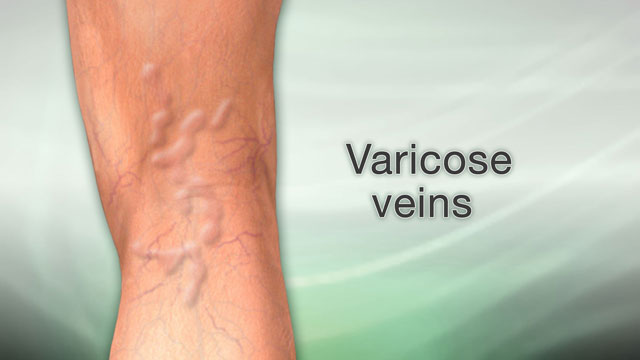 Varicose veins