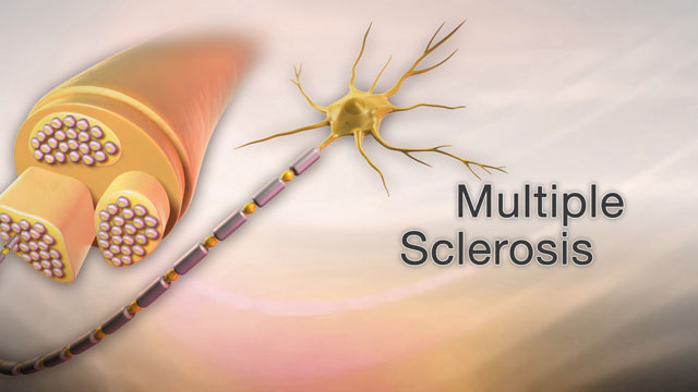 Multiple sclerosis