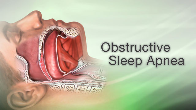 Obstructive sleep apnea