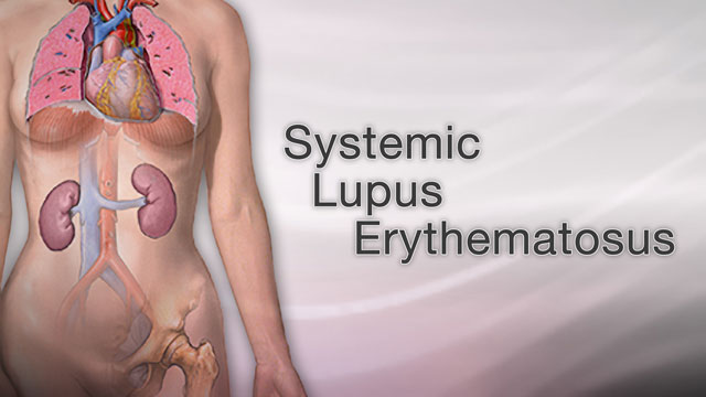 Systemic lupus erythematosus