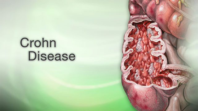 Crohn disease