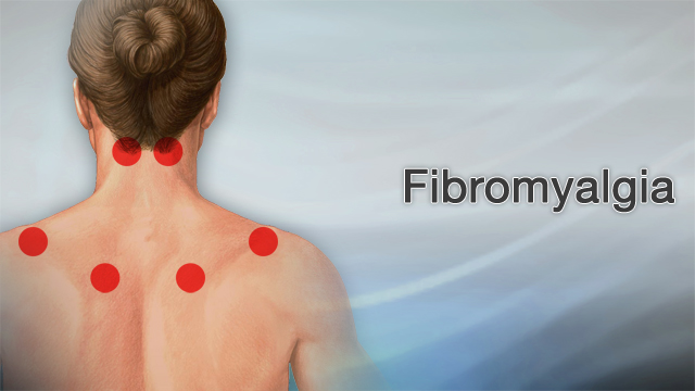 Fibromyalgia Rash: What Helps Itching and Burning?